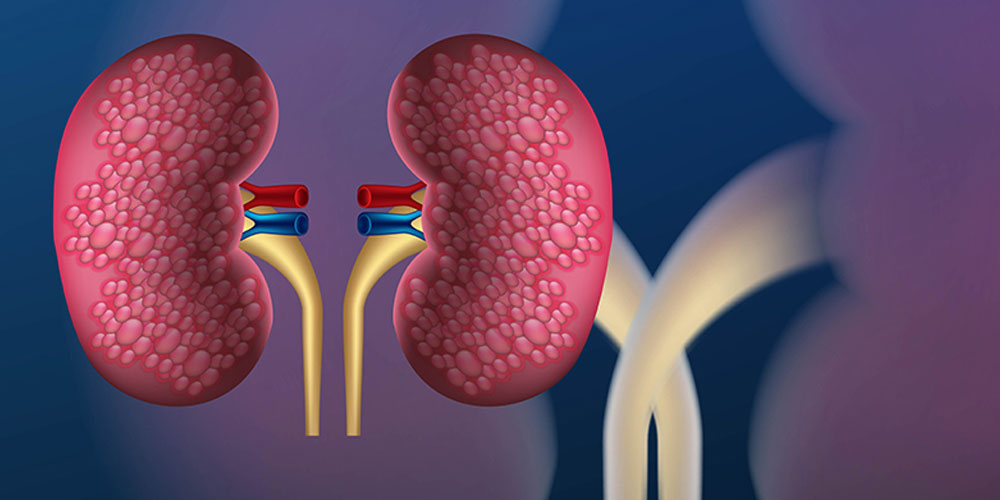 Diabetes & Kidney Disease Diabetes & Kidney Disease