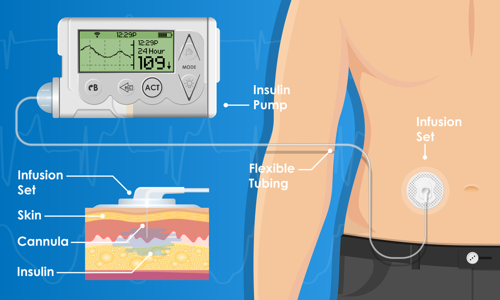 Latest Diabetes Technology Latest Diabetes Technology